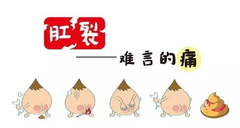 肛裂：那些你可能不知道的事
