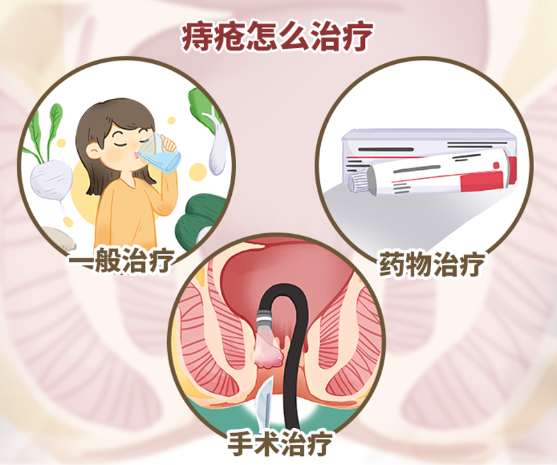 痔疮治疗