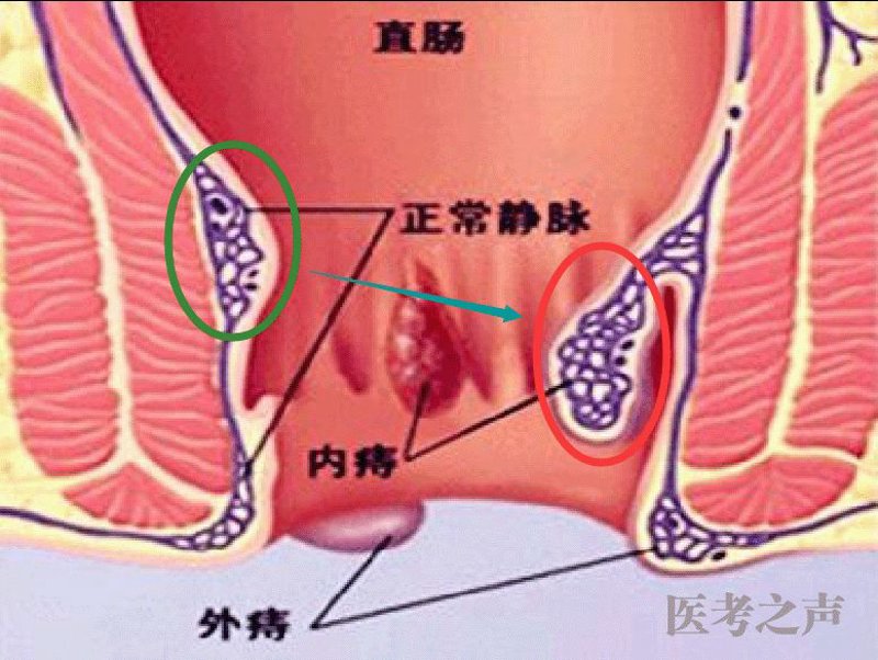 肛裂：常见疾病与防治指南